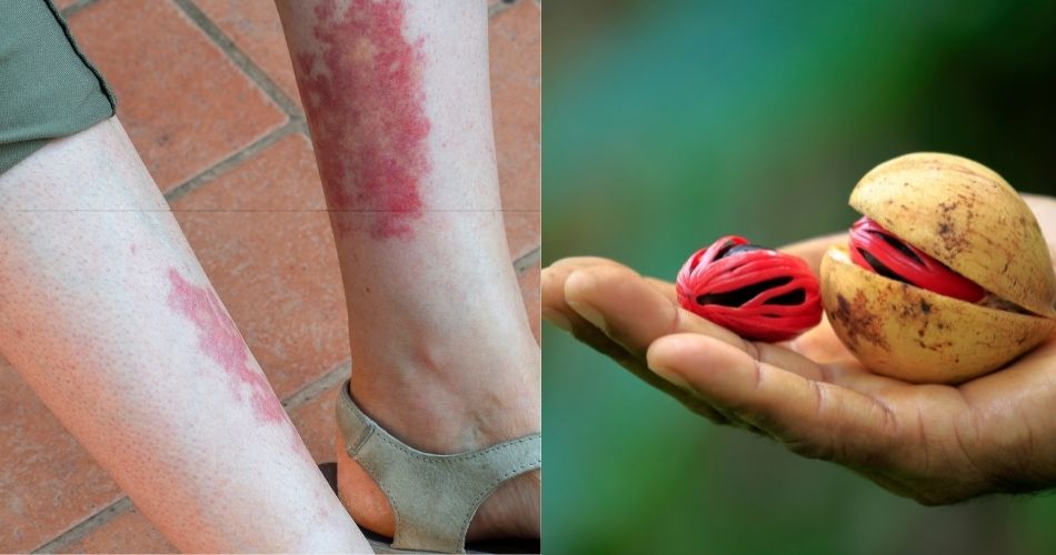 Nutmeg is an excellent anti-inflammatory remedy
