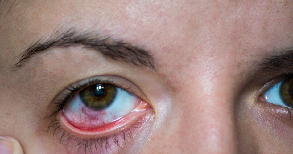 Antioxidants levels present in the Horse Gram helps combat the eye infection, giving it a soothing effect